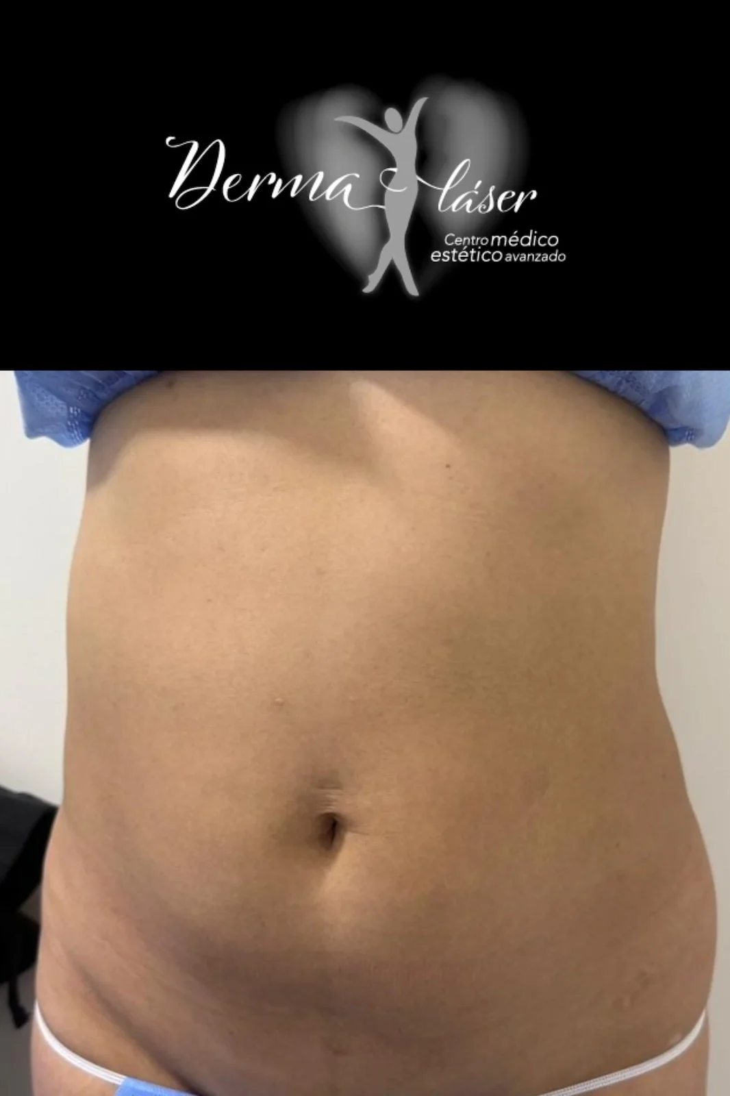 DERMALASSR ANTES (1)