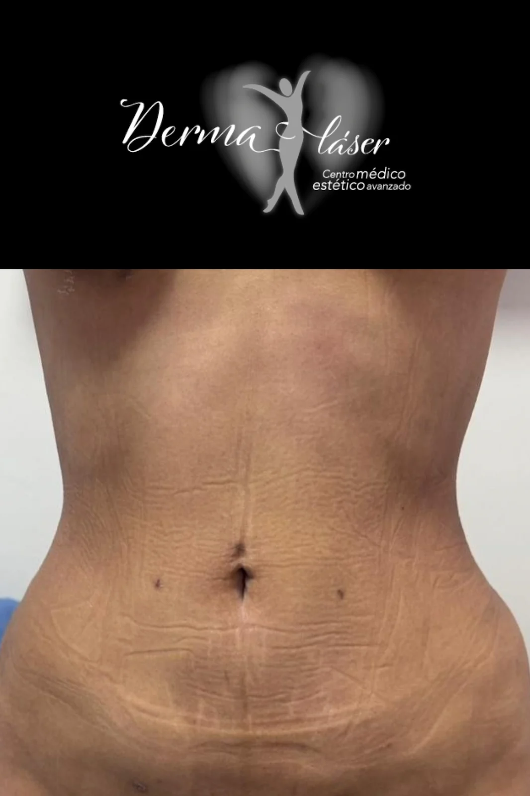 DERMALASSR DESPUES (1)