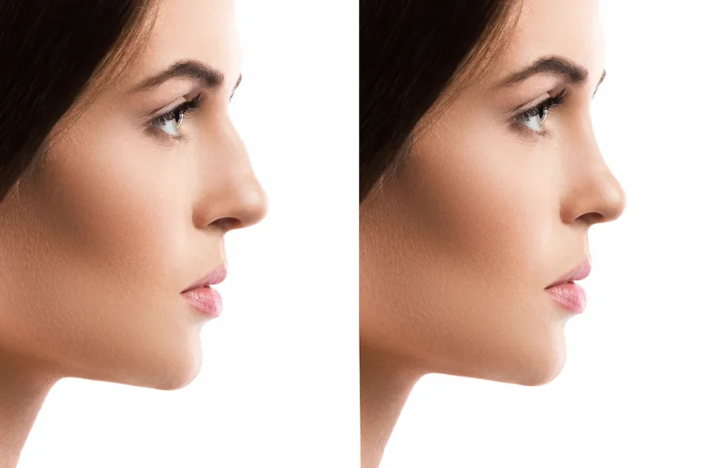 Antes y después de una rinomodelación con ácido hialurónico para disimular un tabique nasal desviado