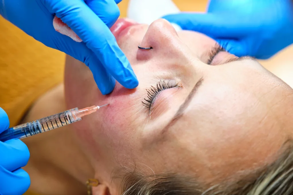 Aplicación de ácido hialurónico en pómulo como parte de un plan de armonización facial