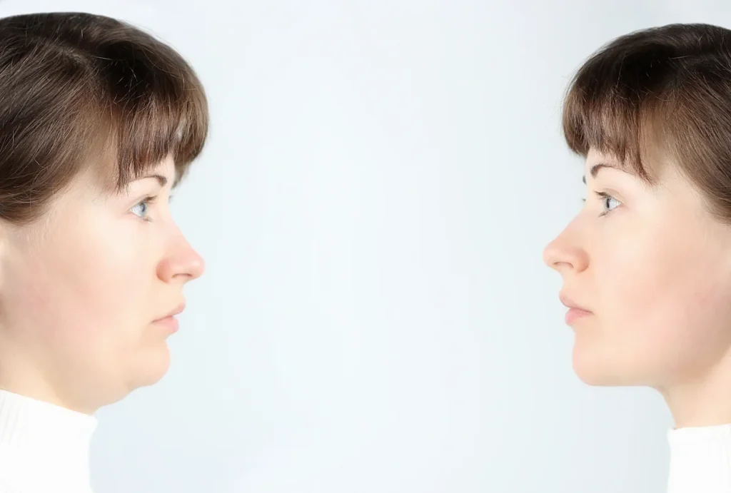 Comparación de bichectomía antes y después en el contorno facial de una paciente