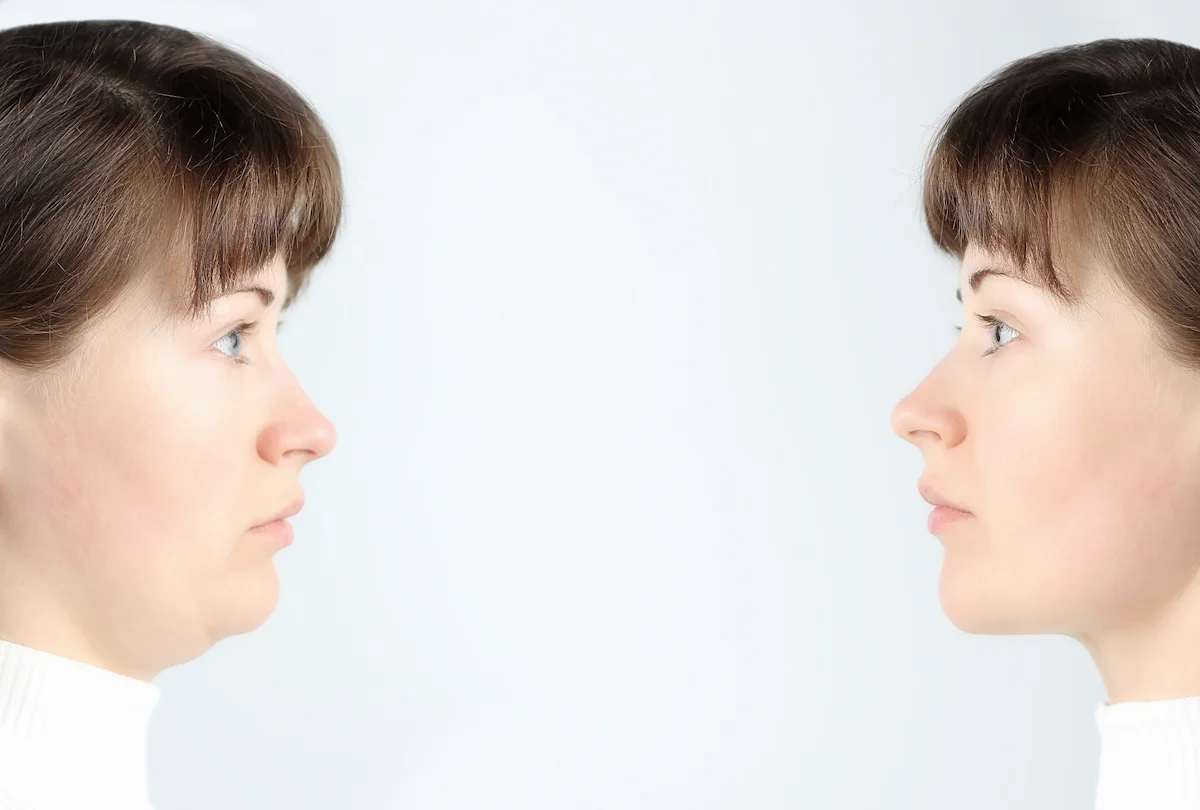 Comparación de bichectomía antes y después en el contorno facial de una paciente