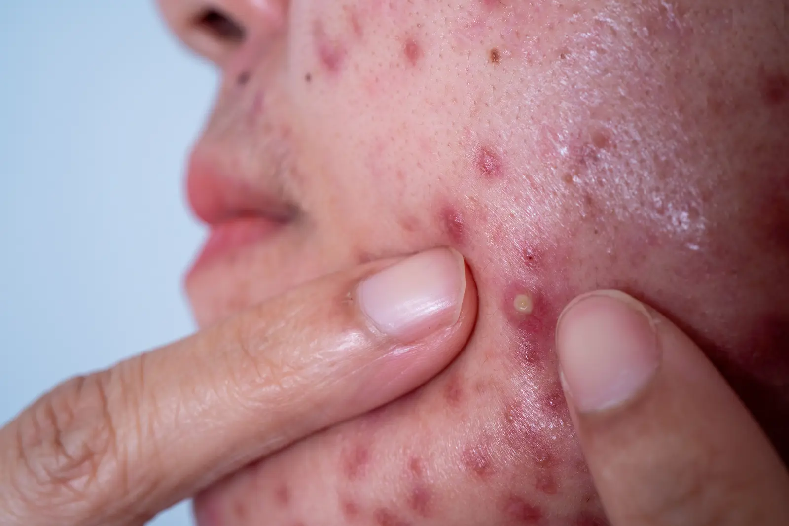 espinillas dermalaser